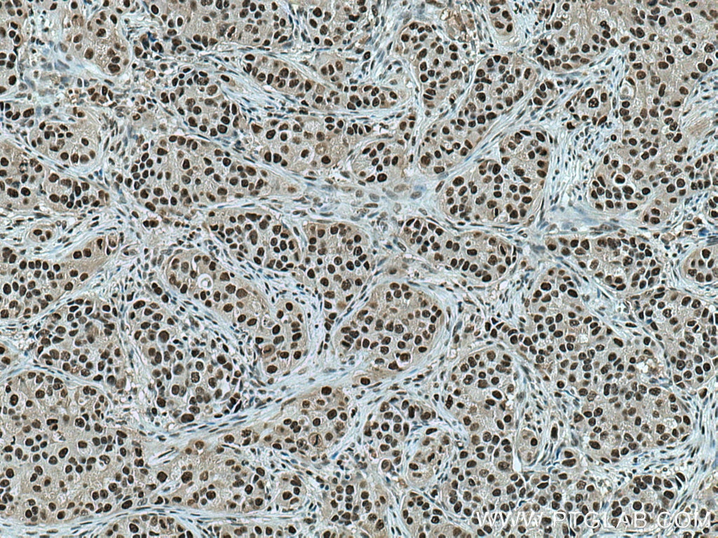 IHC staining of human breast cancer using 60097-1-Ig