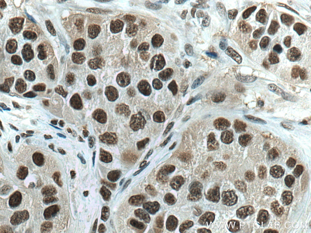 Immunohistochemistry (IHC) staining of human breast cancer tissue using PCNA Monoclonal antibody (60097-1-Ig)