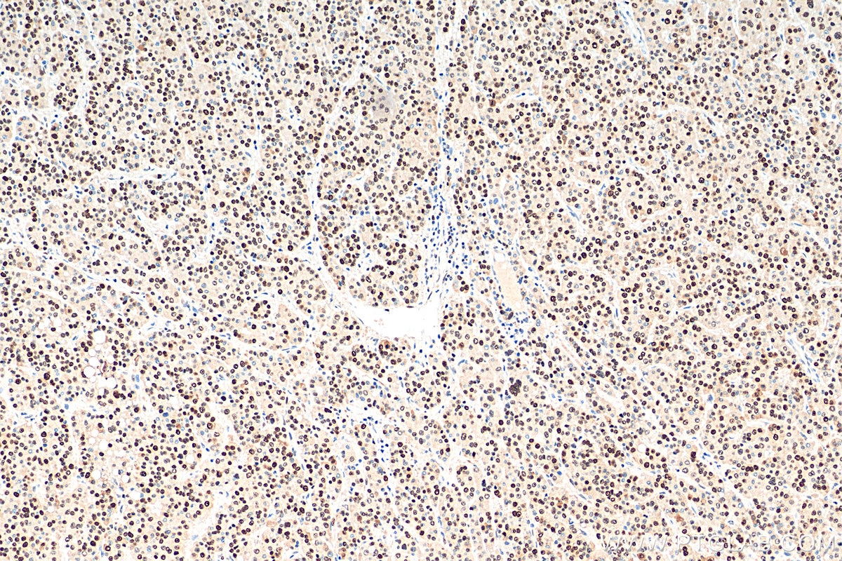 Immunohistochemistry (IHC) staining of human liver cancer tissue using PCNA Monoclonal antibody (60097-1-Ig)