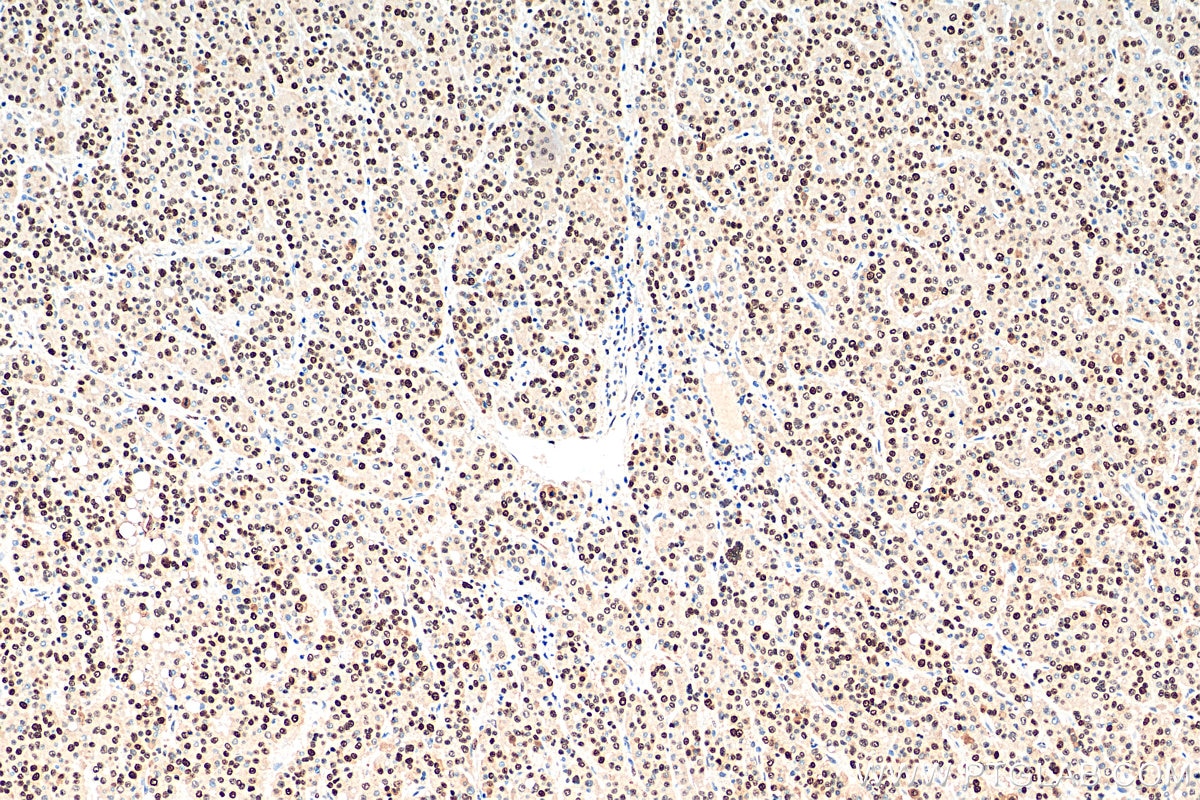 IHC staining of human liver cancer using 60097-1-Ig