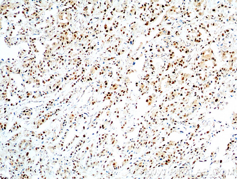 IHC staining of human breast cancer using 60097-1-Ig