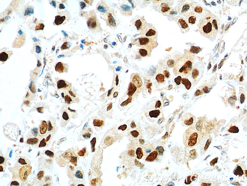 Immunohistochemistry (IHC) staining of human breast cancer tissue using PCNA Monoclonal antibody (60097-1-Ig)