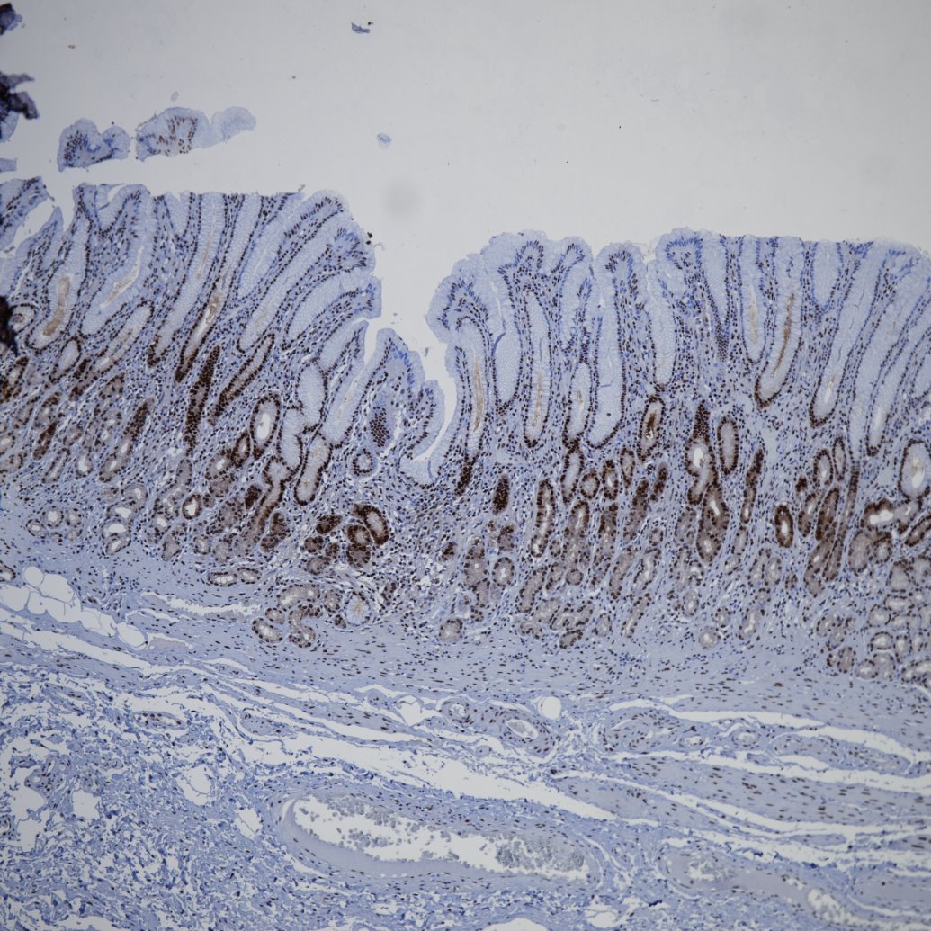Immunohistochemistry (IHC) staining of human stomach cancer tissue using PCNA Recombinant monoclonal antibody (81302-6-RR)