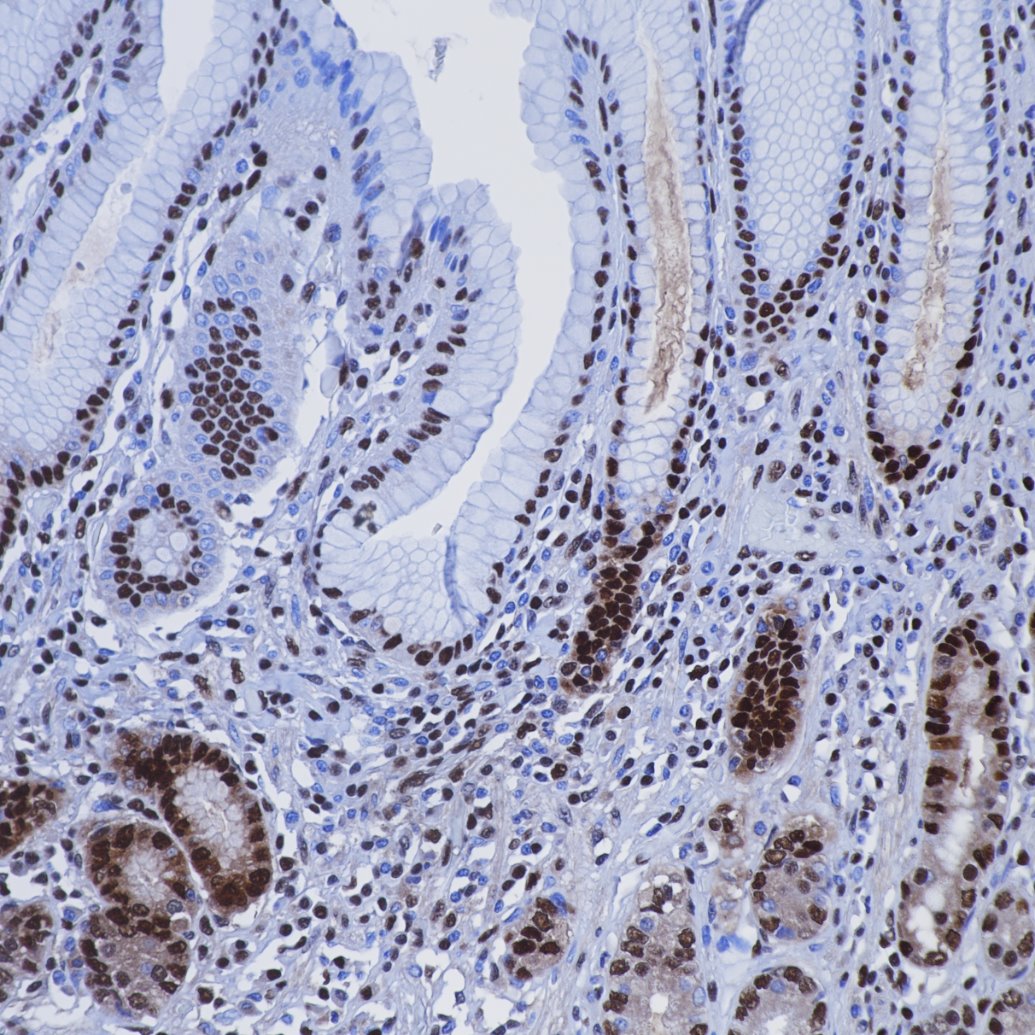Immunohistochemistry (IHC) staining of human stomach cancer tissue using PCNA Recombinant monoclonal antibody (81302-6-RR)