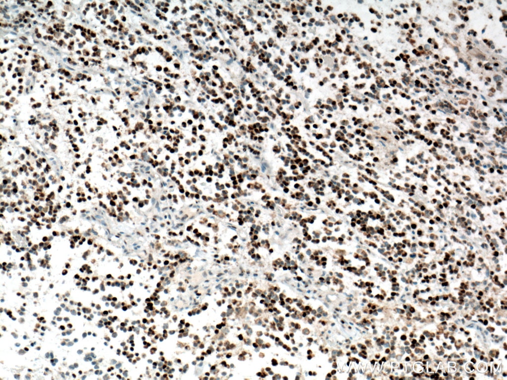 Immunohistochemistry (IHC) staining of human gliomas tissue using Biotin-conjugated PCNA Monoclonal antibody (Biotin-60097)