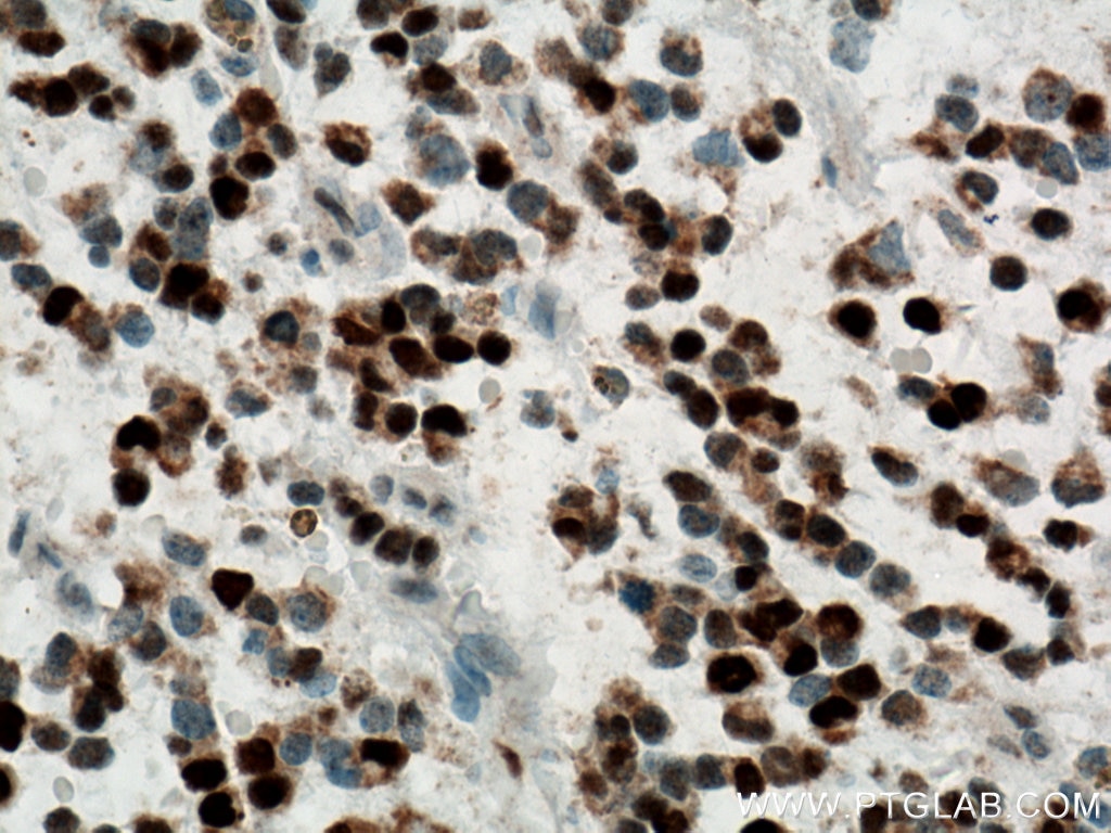 Immunohistochemistry (IHC) staining of human gliomas tissue using Biotin-conjugated PCNA Monoclonal antibody (Biotin-60097)