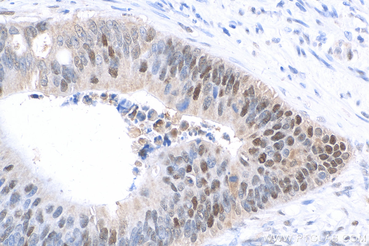 Immunohistochemistry (IHC) staining of human colon cancer tissue using Biotin-conjugated PCNA Monoclonal antibody (Biotin-60097)
