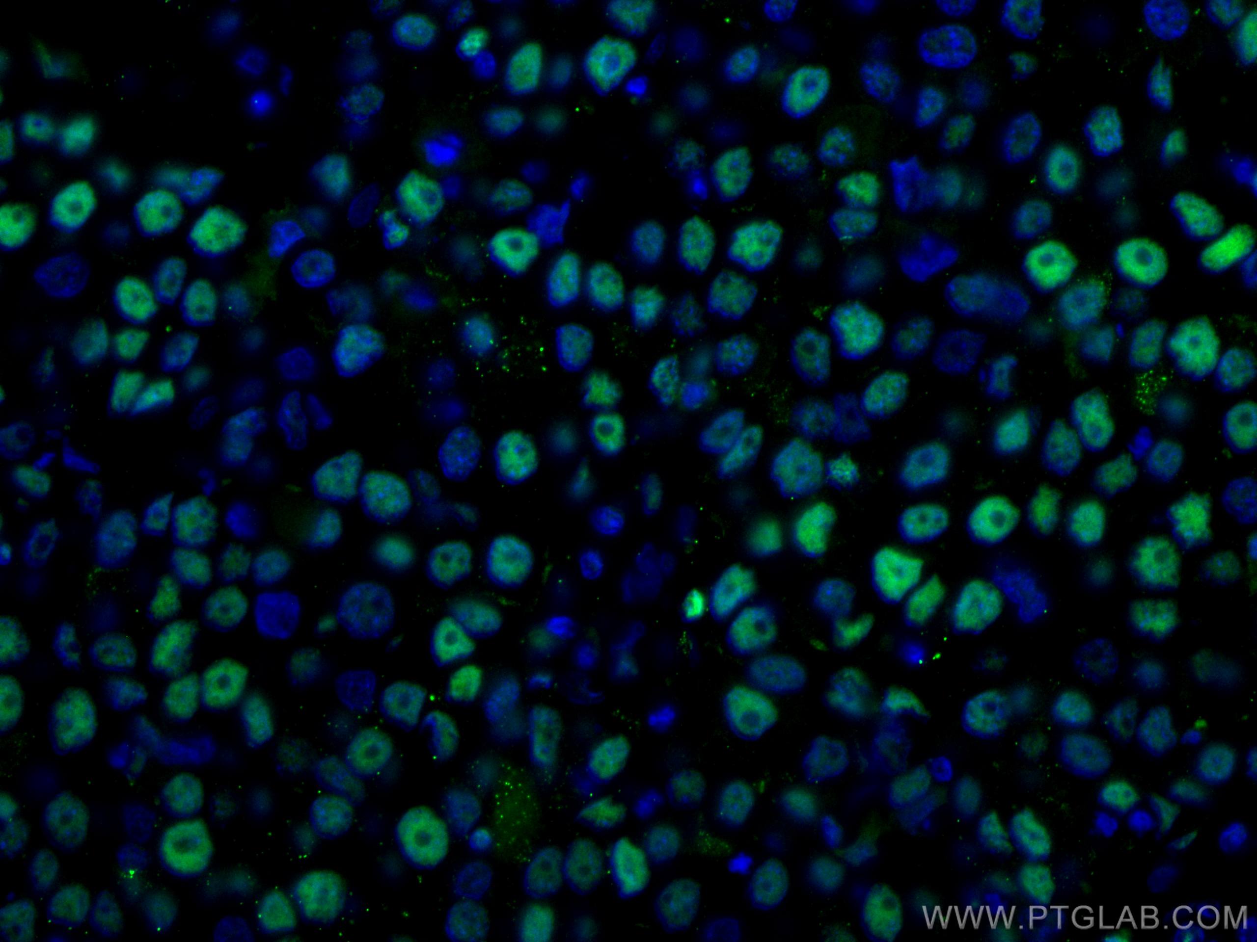 Immunofluorescence (IF) / fluorescent staining of human breast cancer tissue using CoraLite® Plus 488-conjugated PCNA Polyclonal anti (CL488-10205)