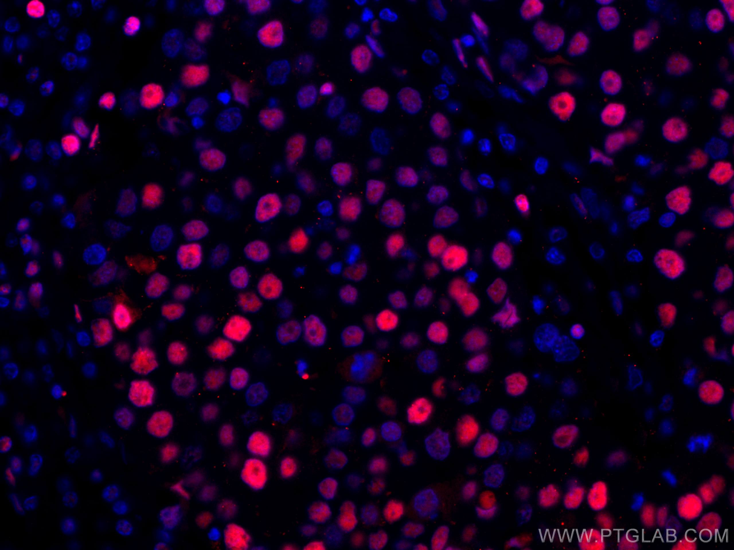 IF Staining of human breast cancer using CL594-10205