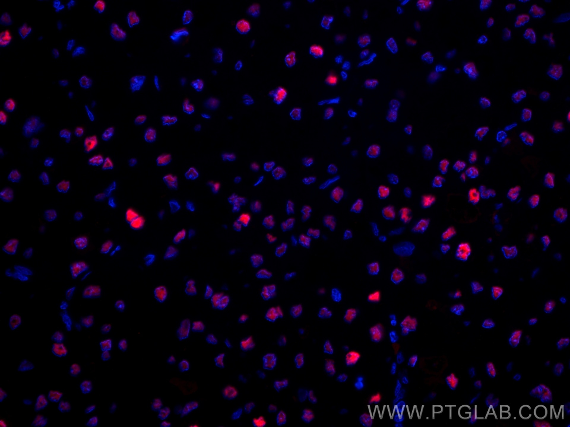 Immunofluorescence (IF) / fluorescent staining of human liver cancer tissue using CoraLite®594-conjugated PCNA Polyclonal antibody (CL594-10205)