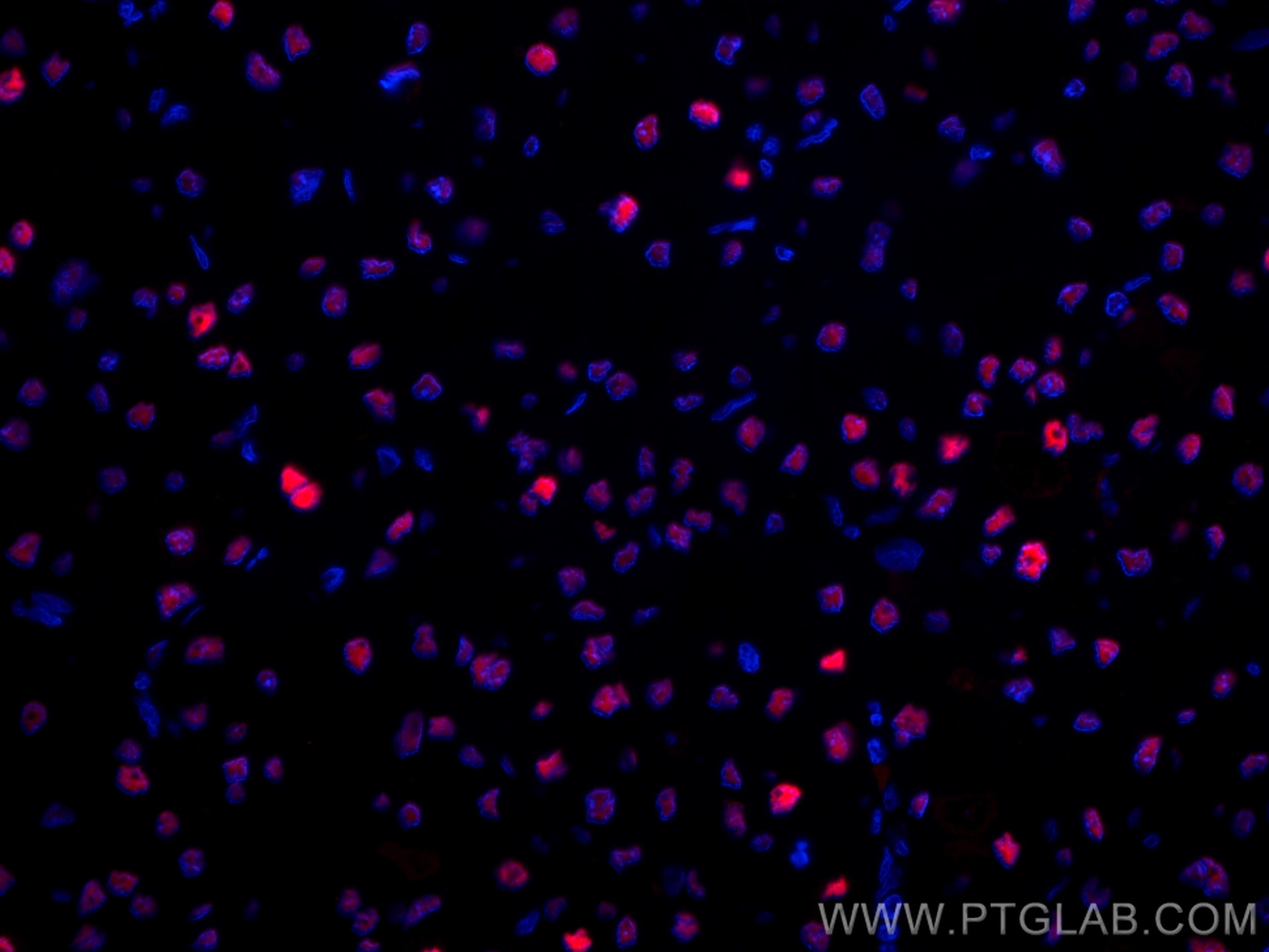 IF Staining of human liver cancer using CL594-10205