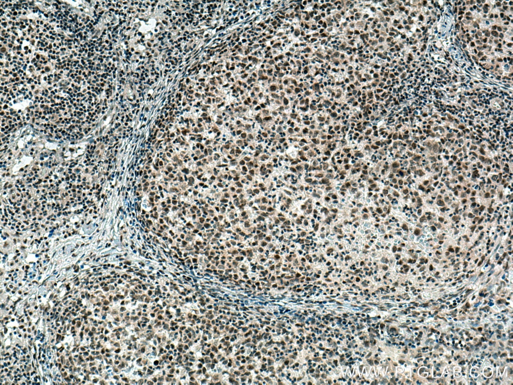 Immunohistochemistry (IHC) staining of human lymphoma tissue using PCNP Polyclonal antibody (11180-2-AP)