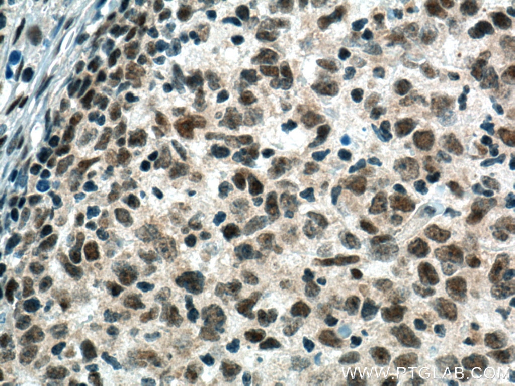 Immunohistochemistry (IHC) staining of human lymphoma tissue using PCNP Polyclonal antibody (11180-2-AP)