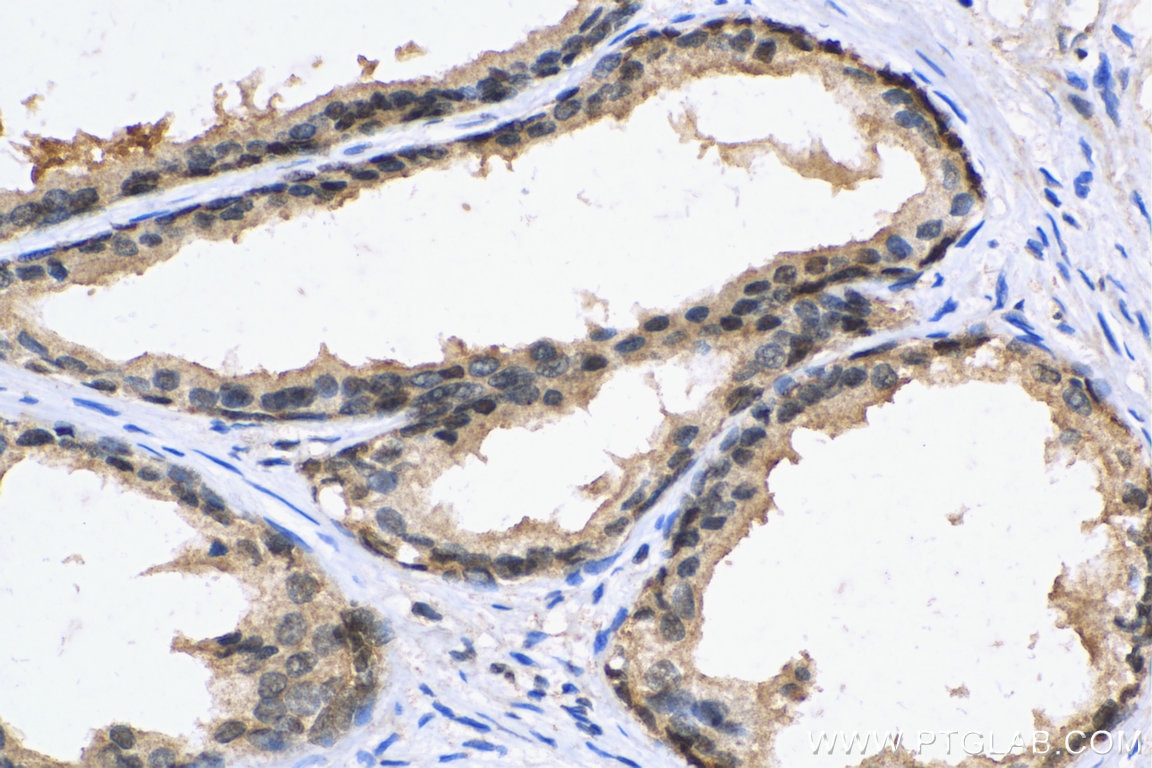 Immunohistochemistry (IHC) staining of human prostate cancer tissue using PCNP Polyclonal antibody (29305-1-AP)