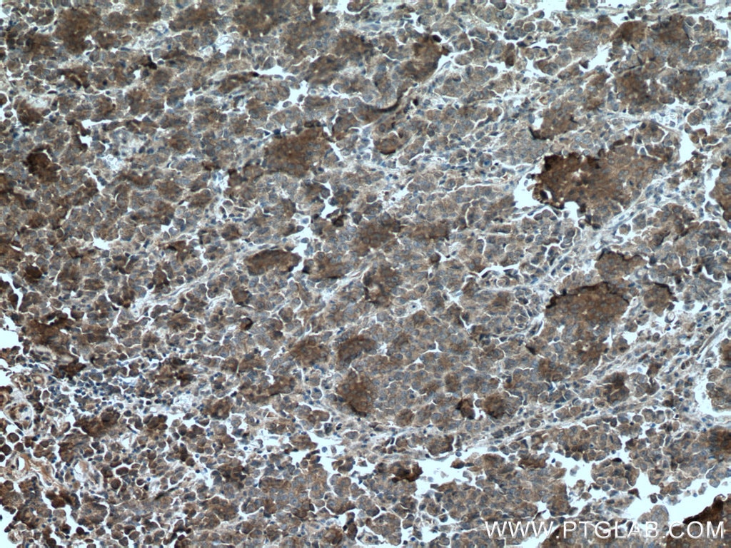 Immunohistochemistry (IHC) staining of human prostate cancer tissue using PCOTH Polyclonal antibody (24564-1-AP)