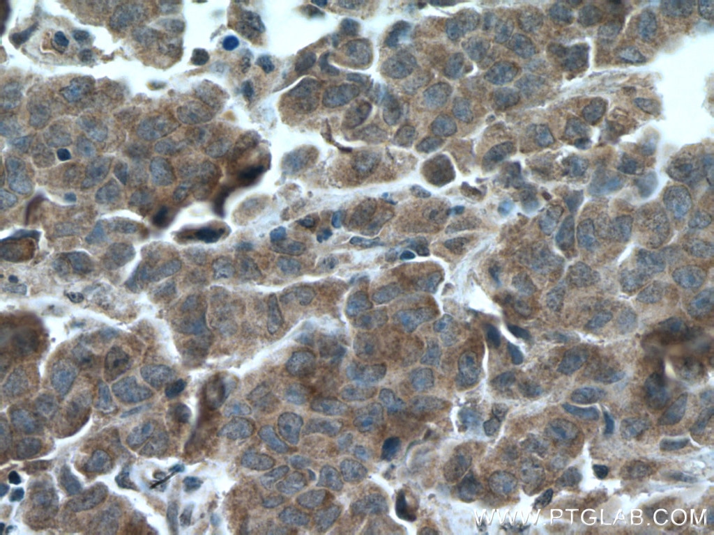 Immunohistochemistry (IHC) staining of human prostate cancer tissue using PCOTH Polyclonal antibody (24564-1-AP)