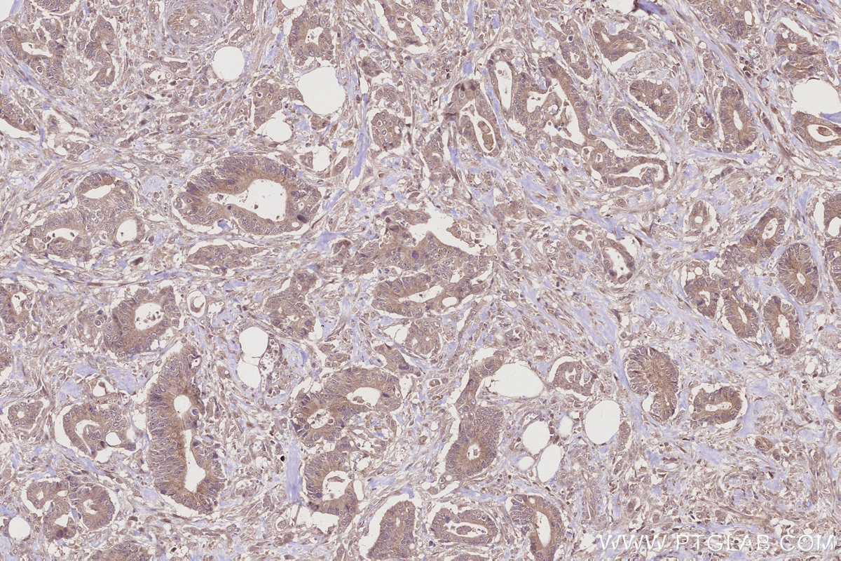 Immunohistochemistry (IHC) staining of human rectal cancer tissue using PCSK5 Polyclonal antibody (16470-1-AP)