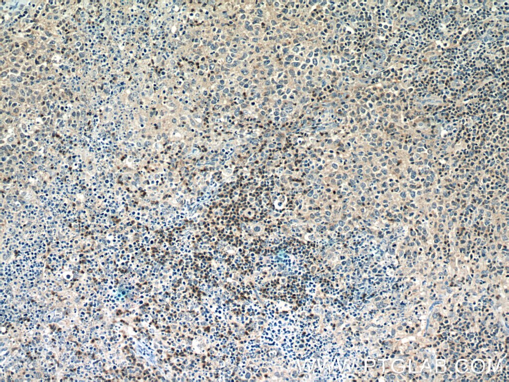 Immunohistochemistry (IHC) staining of human lymphoma tissue using PCSK7 Polyclonal antibody (12044-1-AP)