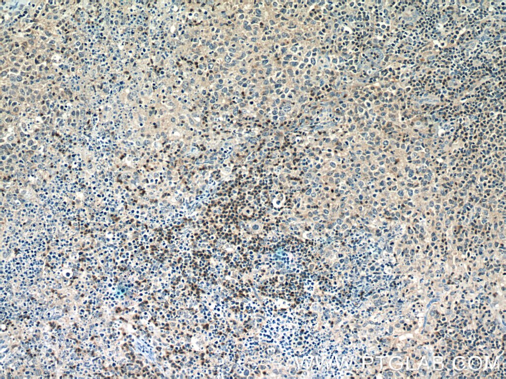 Immunohistochemistry (IHC) staining of human lymphoma tissue using PCSK7 Polyclonal antibody (12044-1-AP)