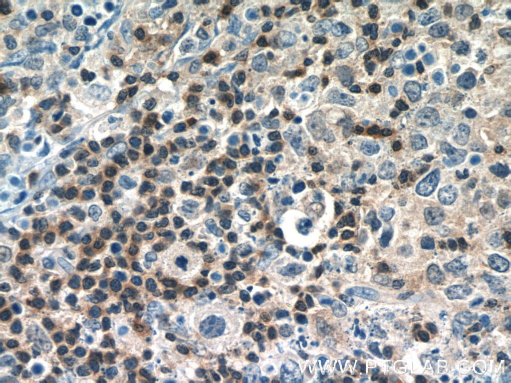 Immunohistochemistry (IHC) staining of human lymphoma tissue using PCSK7 Polyclonal antibody (12044-1-AP)