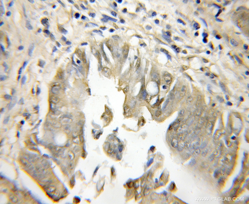 Immunohistochemistry (IHC) staining of human colon cancer tissue using PCSK7 Polyclonal antibody (12044-1-AP)