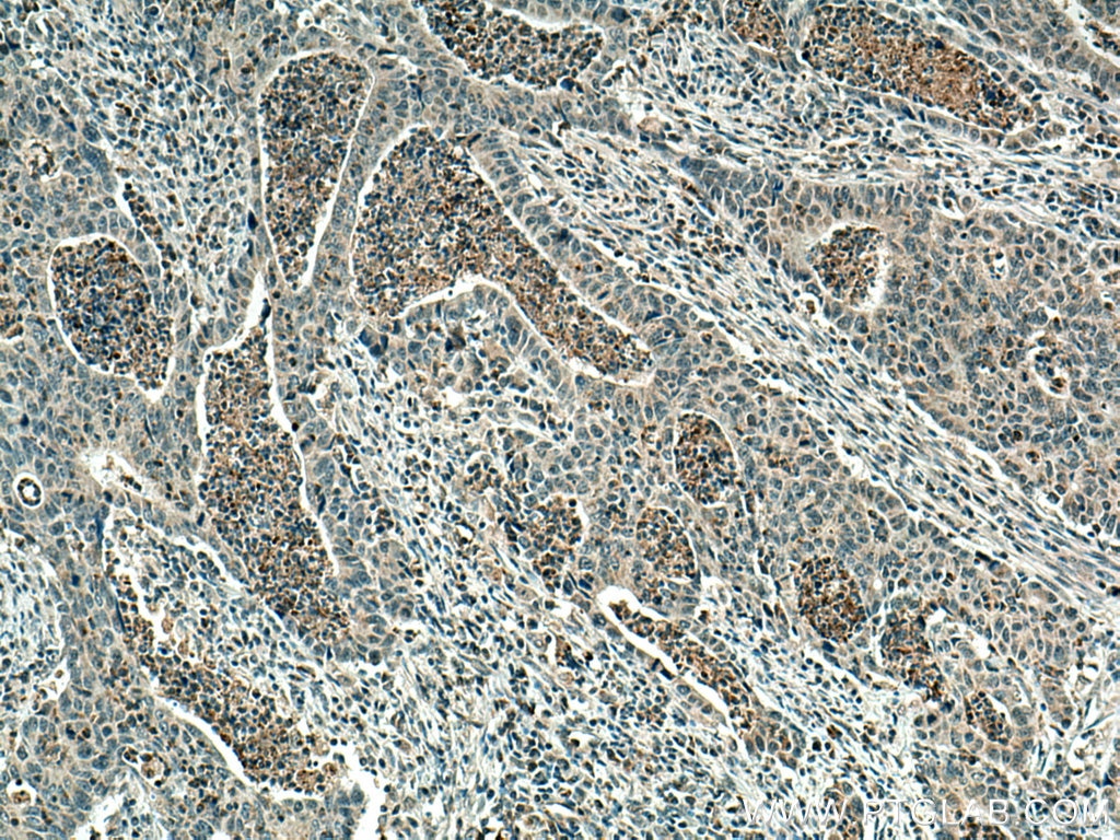 Immunohistochemistry (IHC) staining of human colon cancer tissue using PCSK9 Polyclonal antibody (55206-1-AP)