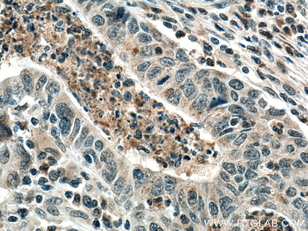 Immunohistochemistry (IHC) staining of human colon cancer tissue using PCSK9 Polyclonal antibody (55206-1-AP)