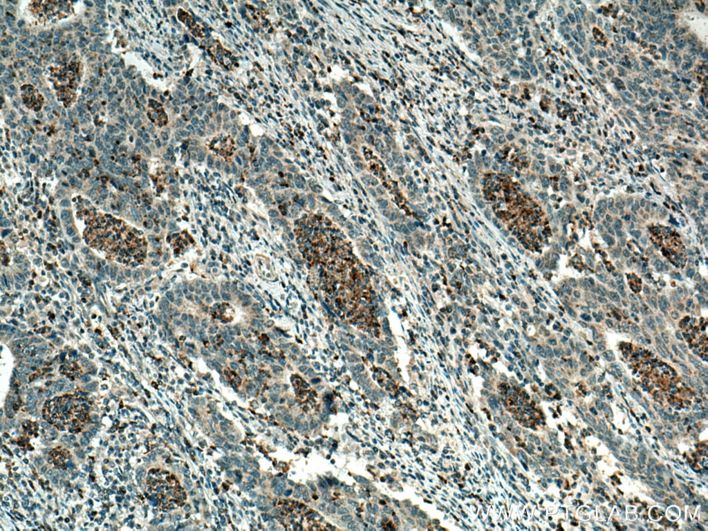 Immunohistochemistry (IHC) staining of human colon cancer tissue using PCSK9 Polyclonal antibody (55206-1-AP)