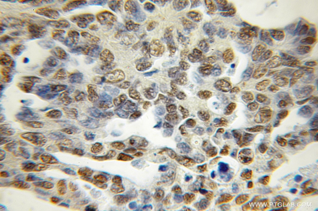 Immunohistochemistry (IHC) staining of human ovary tumor tissue using PCTP Polyclonal antibody (11167-1-AP)