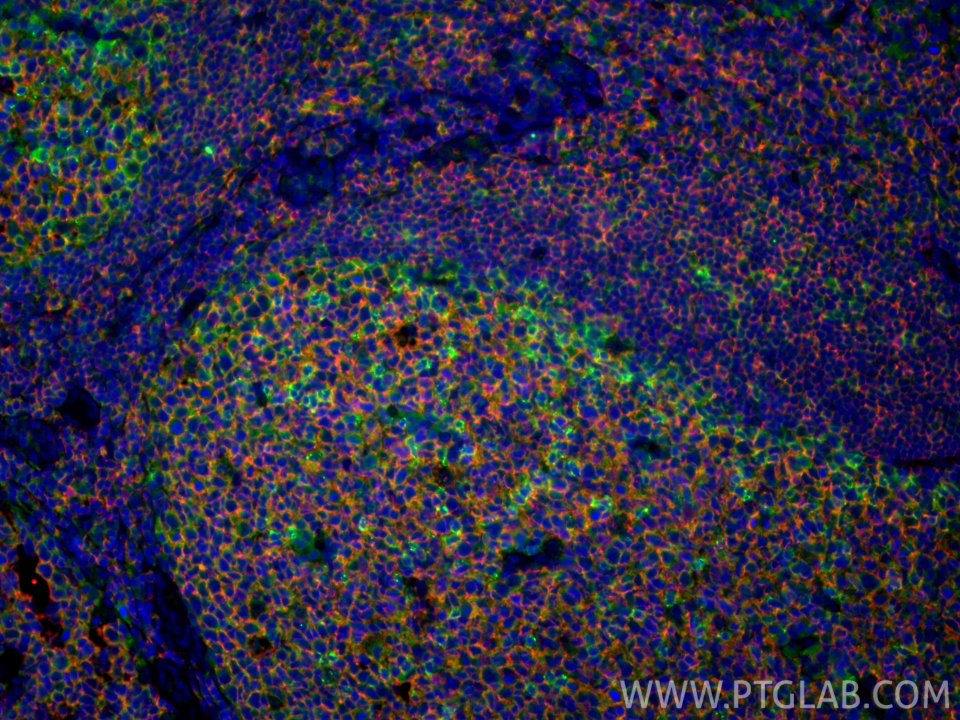 IF Staining of human tonsillitis using 31512-1-AP Immunofluorescence (IF) / fluorescent staining of human tonsillitis tissue using PD-1/CD279 Polyclonal antibody (31512-1-AP)