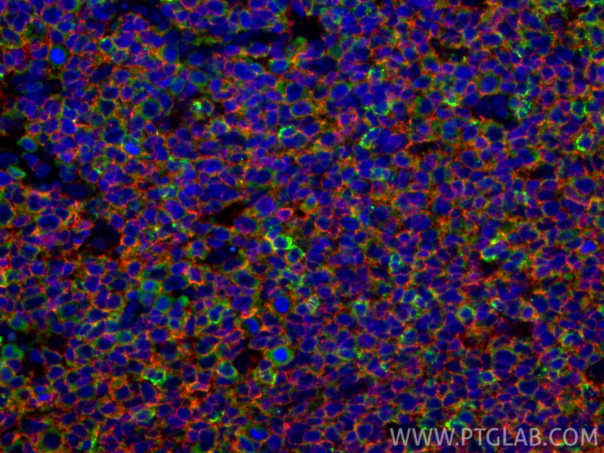 IF Staining of human tonsillitis using 31512-1-AP Immunofluorescence (IF) / fluorescent staining of human tonsillitis tissue using PD-1/CD279 Polyclonal antibody (31512-1-AP)
