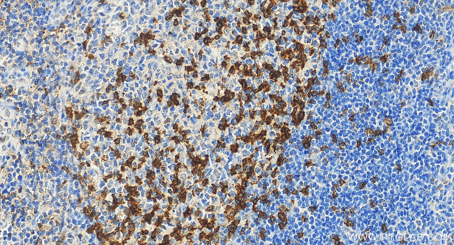 IHC staining of human tonsillitis using 31512-1-AP Immunohistochemistry (IHC) staining of human tonsillitis tissue using PD-1/CD279 Polyclonal antibody (31512-1-AP)