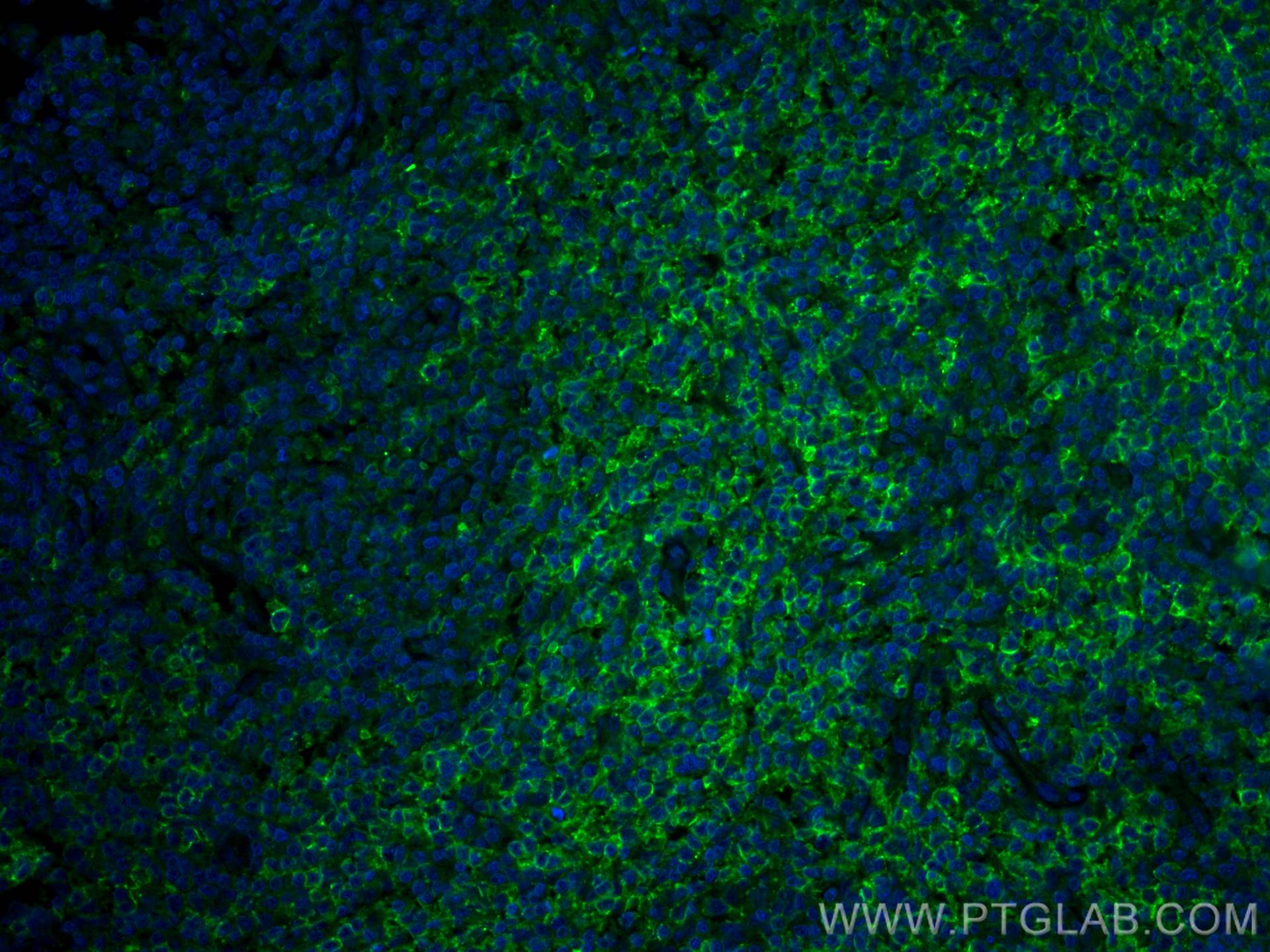 Immunofluorescence (IF) / fluorescent staining of human lymphoma tissue using PD-1/CD279 Monoclonal antibody (66220-1-Ig)