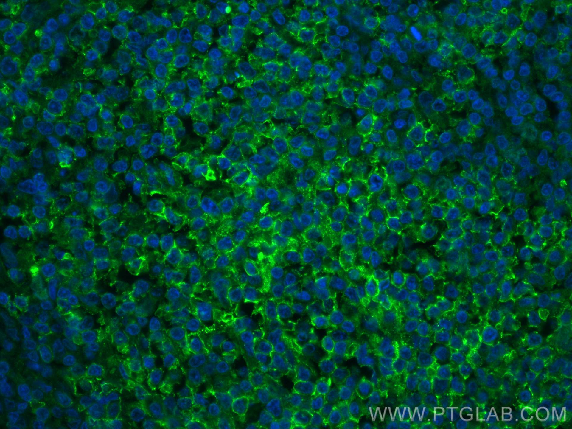 Immunofluorescence (IF) / fluorescent staining of human lymphoma tissue using PD-1/CD279 Monoclonal antibody (66220-1-Ig)