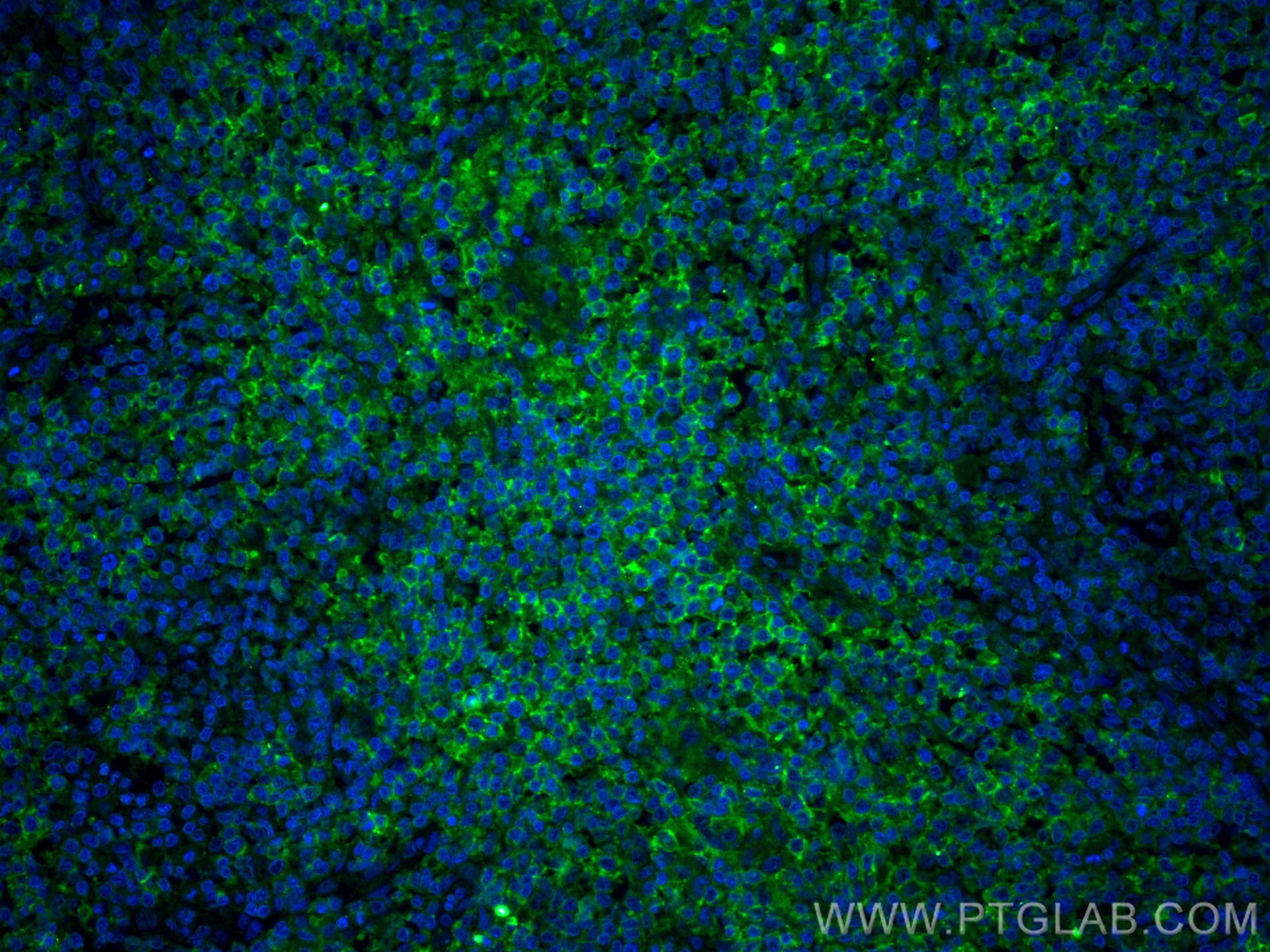 Immunofluorescence (IF) / fluorescent staining of human lymphoma tissue using PD-1/CD279 Monoclonal antibody (66220-1-Ig)