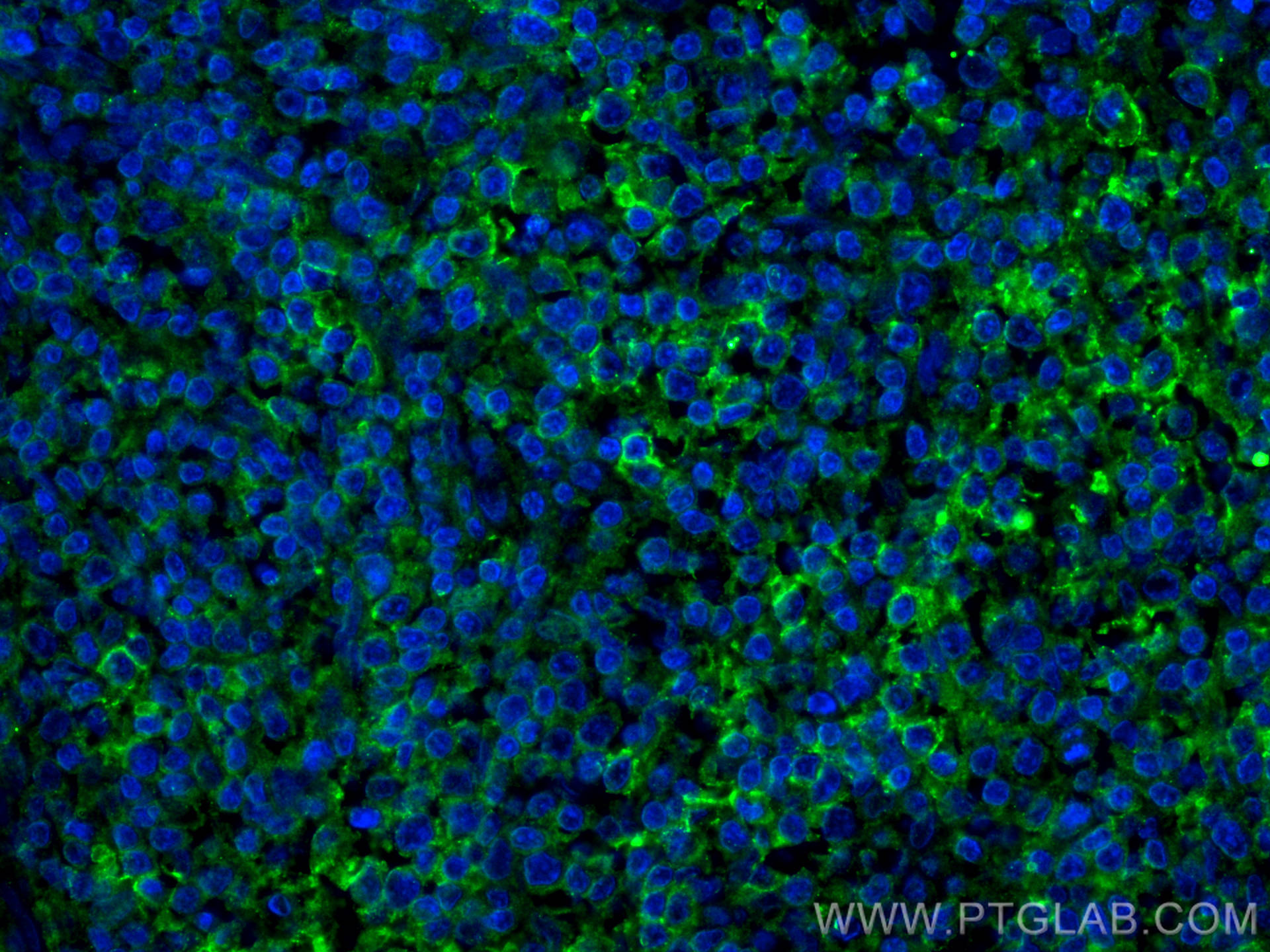 Immunofluorescence (IF) / fluorescent staining of human lymphoma tissue using PD-1/CD279 Monoclonal antibody (66220-1-Ig)
