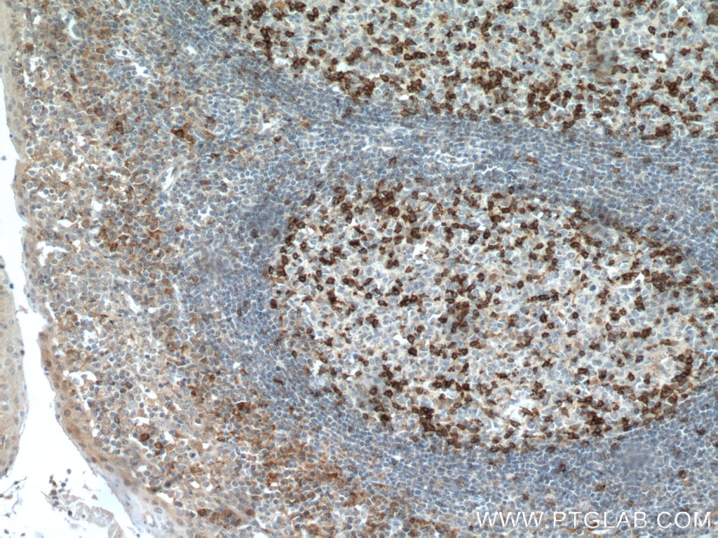 IHC staining of human tonsillitis using 66220-1-Ig