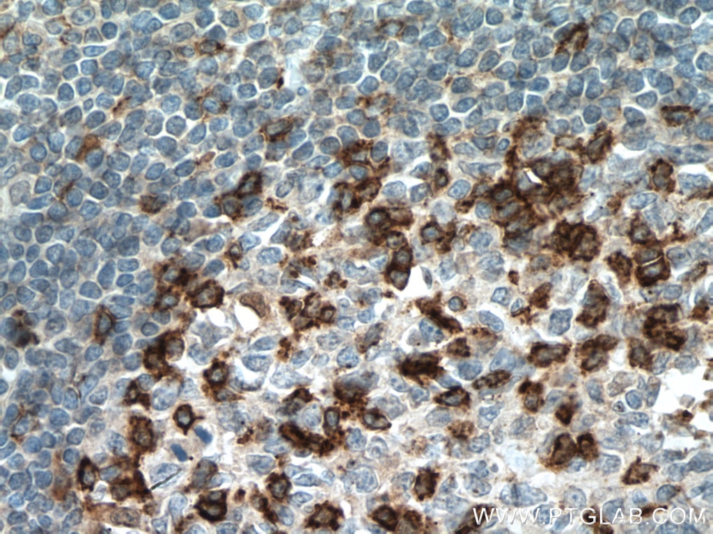 Immunohistochemistry (IHC) staining of human tonsillitis tissue using PD-1/CD279 Monoclonal antibody (66220-1-Ig)