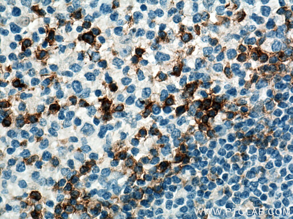 IHC staining of human tonsillitis using 66220-1-Ig