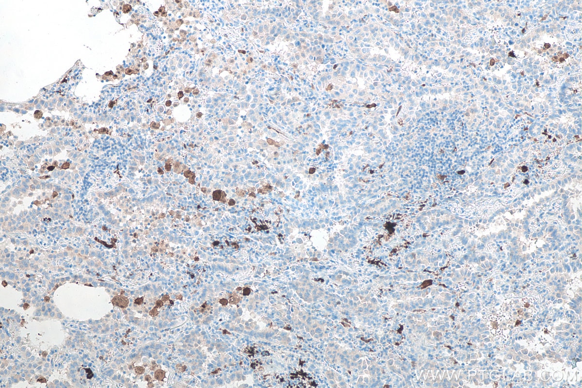 IHC staining of human lung cancer using 66220-1-Ig Immunohistochemistry (IHC) staining of human lung cancer tissue using PD-1/CD279 Monoclonal antibody (66220-1-Ig)