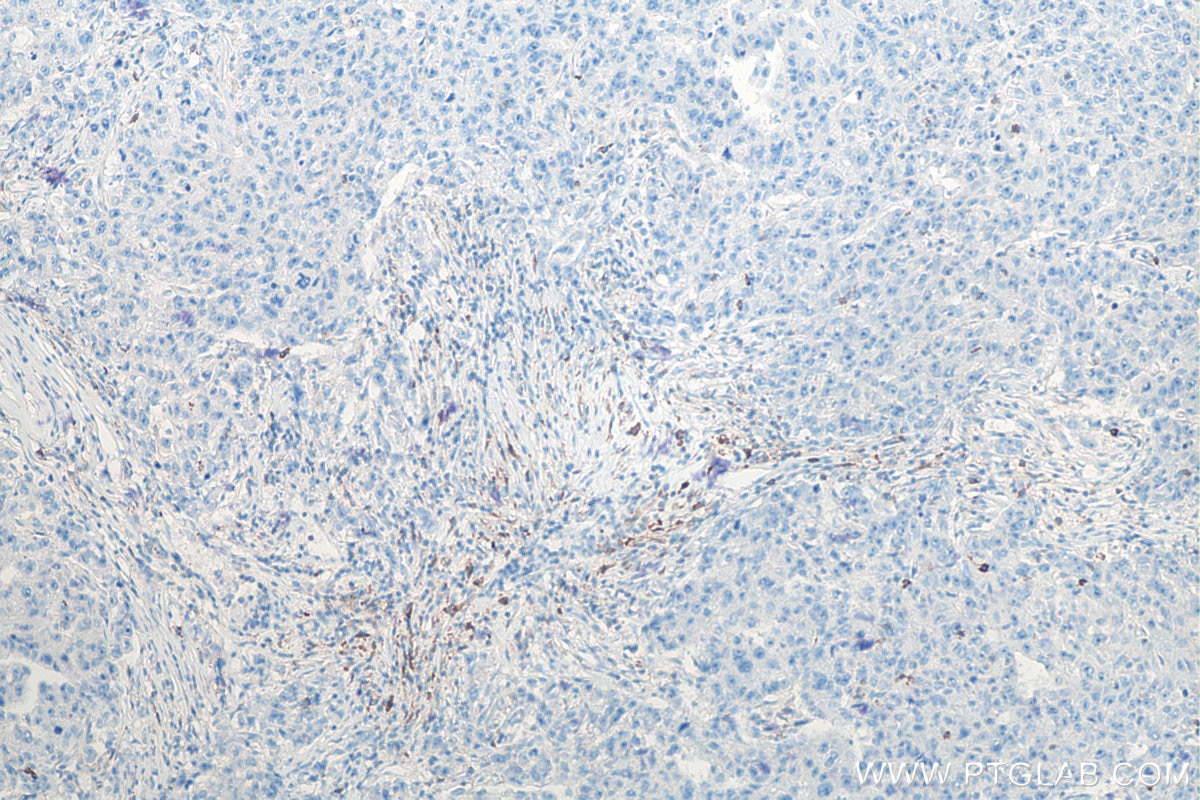 IHC staining of human breast cancer using 66220-1-Ig Immunohistochemistry (IHC) staining of human breast cancer tissue using PD-1/CD279 Monoclonal antibody (66220-1-Ig)