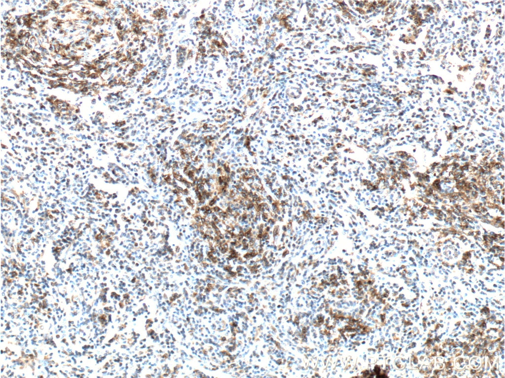 Immunohistochemistry (IHC) staining of human lymphoma tissue using PD-1/CD279 Monoclonal antibody (66220-1-Ig)