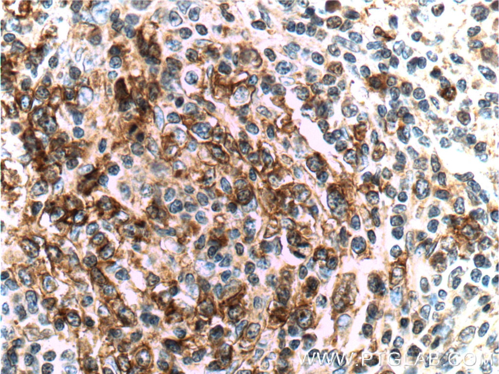 Immunohistochemistry (IHC) staining of human lymphoma tissue using PD-1/CD279 Monoclonal antibody (66220-1-Ig)