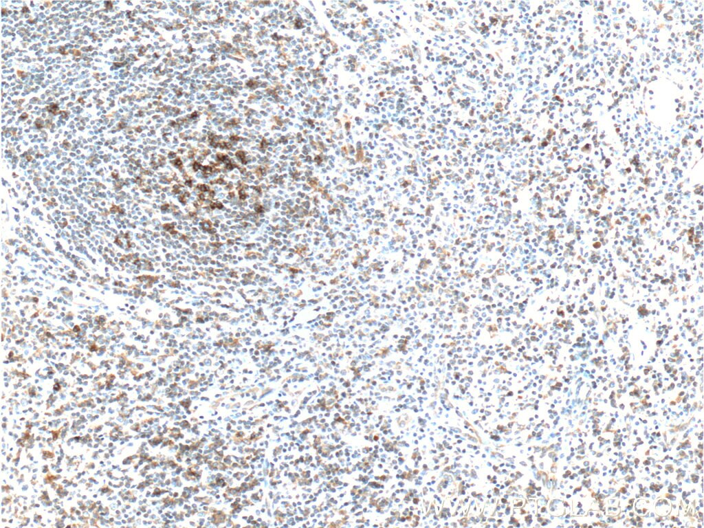 IHC staining of human tonsillitis using 66220-1-Ig