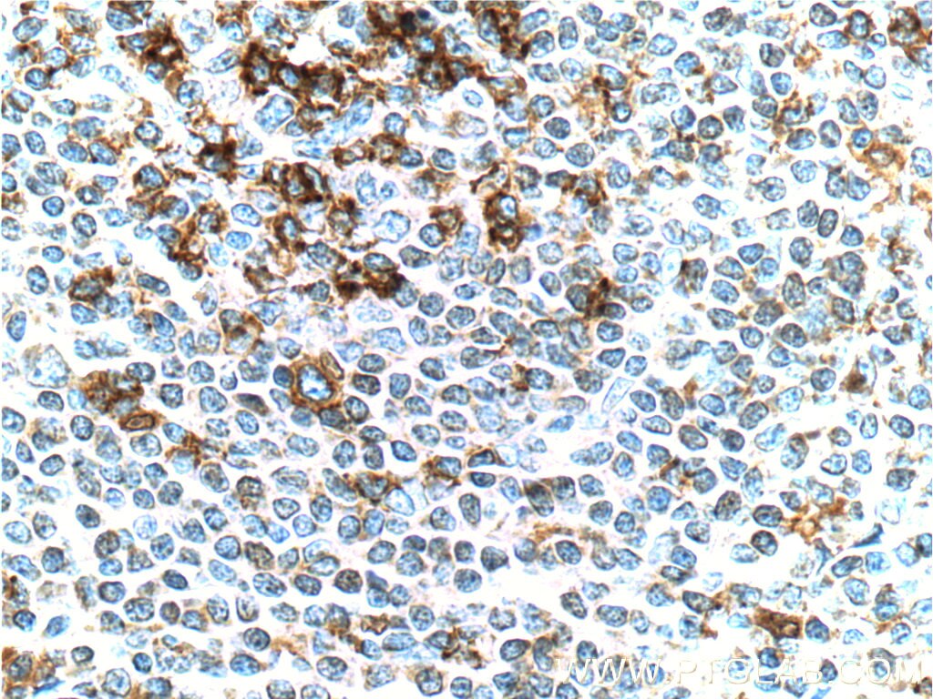 IHC staining of human tonsillitis using 66220-1-Ig