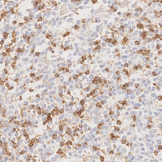 IHC staining of human lymphoma using 66220-1-Ig Immunohistochemistry (IHC) staining of human lymphoma tissue using PD-1/CD279 Monoclonal antibody (66220-1-Ig)