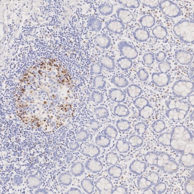 IHC staining of human lymphoma using 66220-1-Ig Immunohistochemistry (IHC) staining of human lymphoma tissue using PD-1/CD279 Monoclonal antibody (66220-1-Ig)