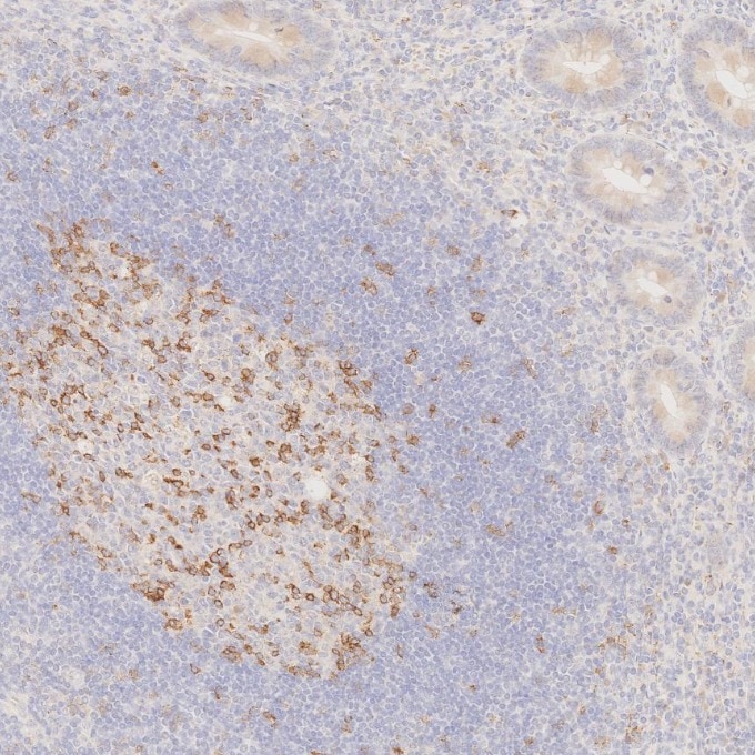 IHC staining of human appendicitis using 66220-1-Ig Immunohistochemistry (IHC) staining of human appendicitis tissue using PD-1/CD279 Monoclonal antibody (66220-1-Ig)