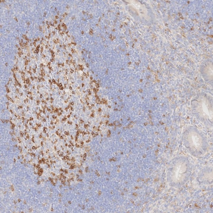 IHC staining of human appendicitis using 66220-1-Ig Immunohistochemistry (IHC) staining of human appendicitis tissue using PD-1/CD279 Monoclonal antibody (66220-1-Ig)