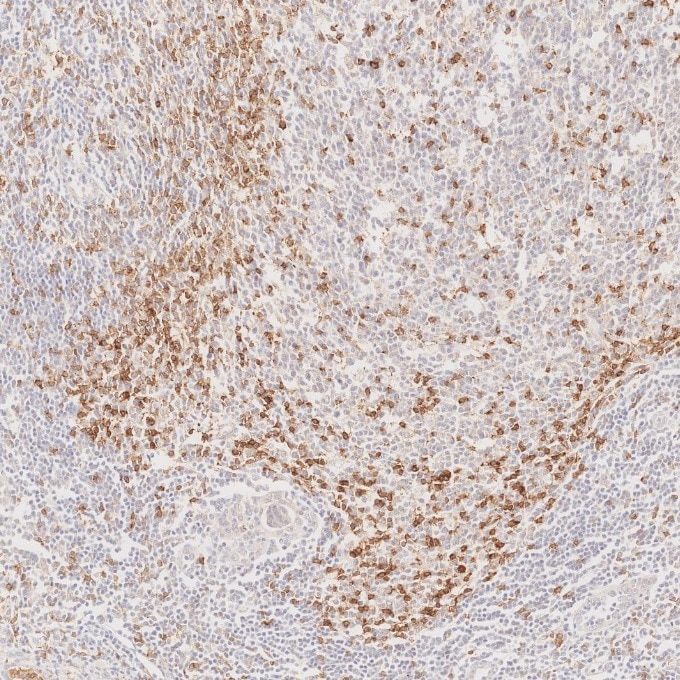 IHC staining of human lymphoma using 66220-1-Ig Immunohistochemistry (IHC) staining of human lymphoma tissue using PD-1/CD279 Monoclonal antibody (66220-1-Ig)